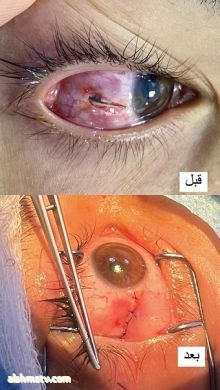 إجراء عملية طارئة لشاب بعمر " ١٧عام" بعد دخول مِسمار في عينهِ أثناء عملهِ